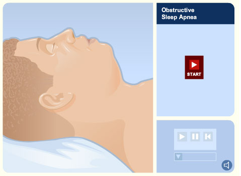 sleep-apnea