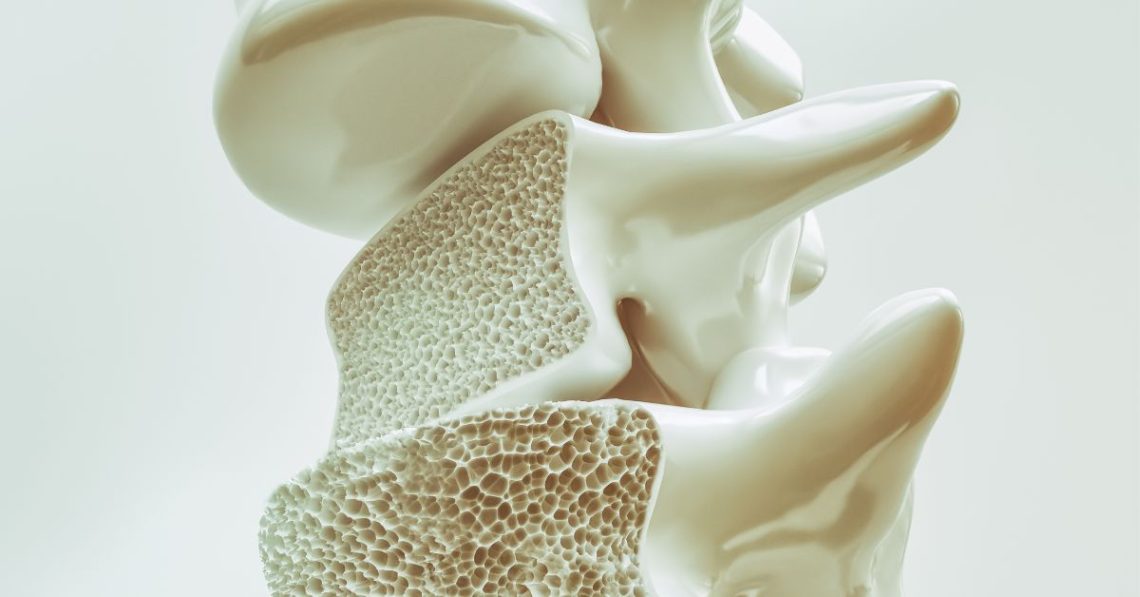 Understanding Osteoporosis: Recognizing Symptoms and When to Seek Help