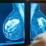 What Is a 3D Mammogram? And Is It Better?
